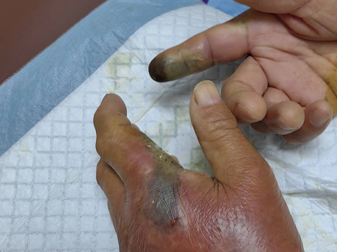 纽约红牛vs哥伦布机员_眼镜王蛇咬伤老人纽约红牛vs哥伦布机员,家属拖两米多长的“凶手”冲进医院!“拎蛇就医”可取吗?