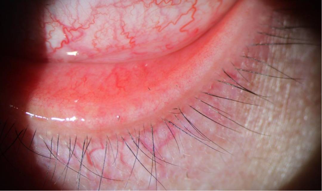 皇冠信用網开户_剧痛!一阵风吹过皇冠信用網开户,女子眼睛被扎进7根“黑刺”……近期多人中招