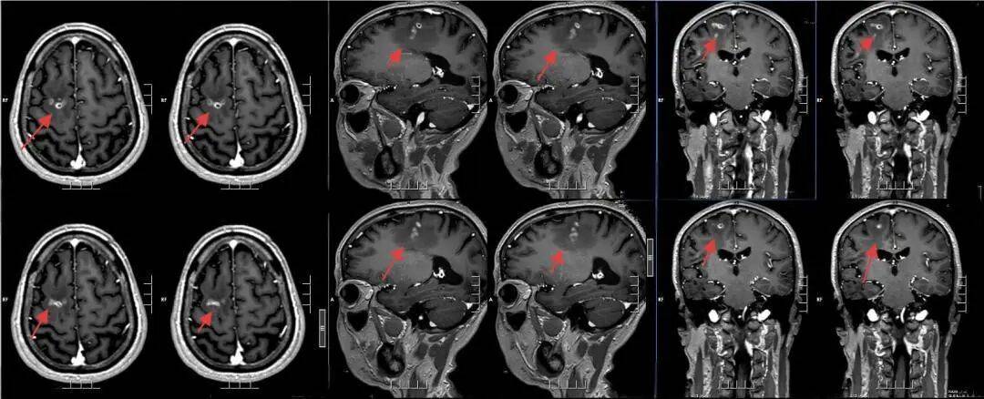 怎么申请皇冠信用网
_广东一男子20多年不敢一个人出门怎么申请皇冠信用网
,医生从他脑中取出10厘米活虫