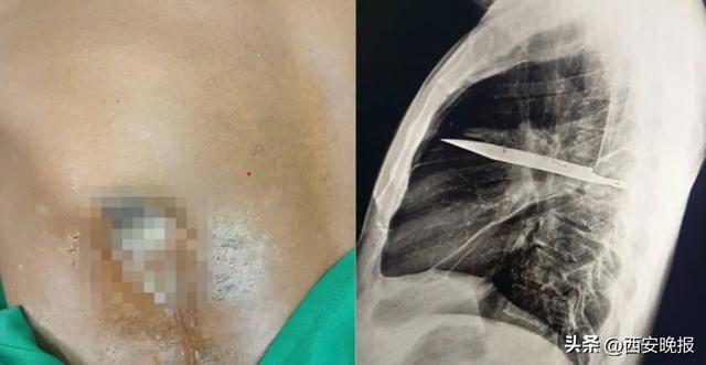 皇冠登3管理出租
_罕见！坦桑尼亚44岁男子胸口流脓发出恶臭皇冠登3管理出租
，照X光才发现有把刀在体内长达8年，刚好避开心脏血管